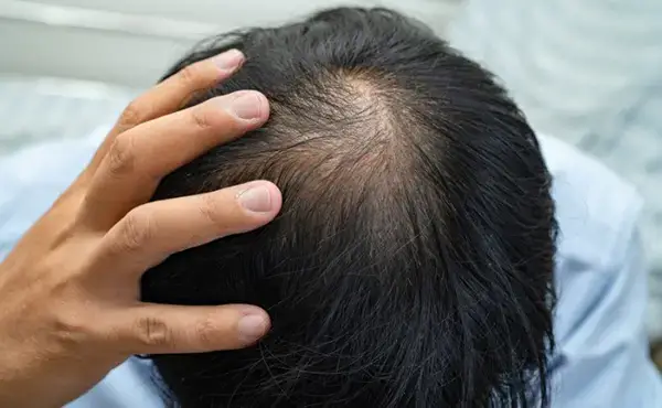 Calvície tem solução? Conheça os tratamentos para queda de cabelo